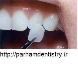 کاشت دندان با کیفیت در کلینیک پرهام